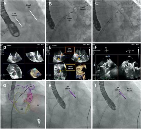 (Open Access) A hybrid echocardiography.